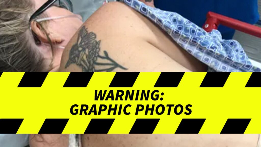 stingray-impales-fl-woman,-gnarly-pics-of-venomous-barb-left-in-her-back